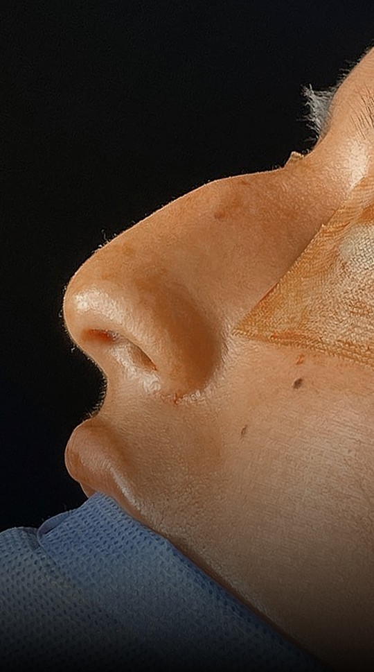 Comparación de perfil nasal antes y después del Caso 01 — antes