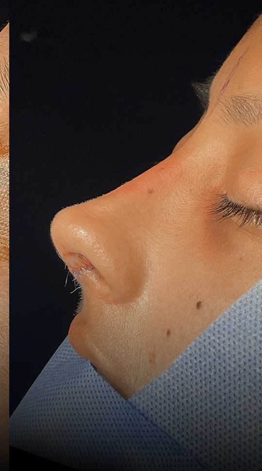 Comparación de perfil nasal antes y después del Caso 01 — después