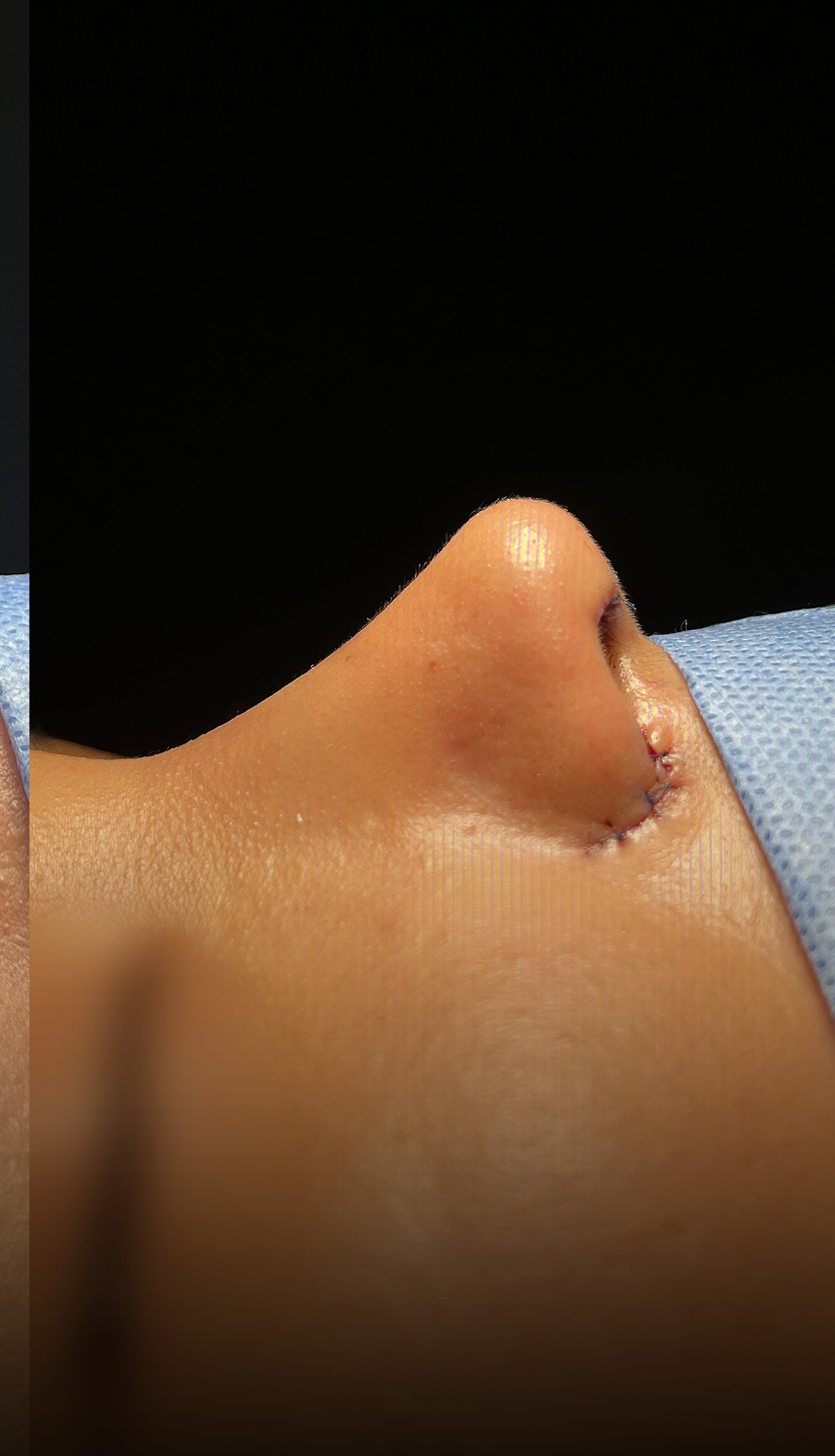 Comparación de perfil nasal antes y después del Caso 01 — después