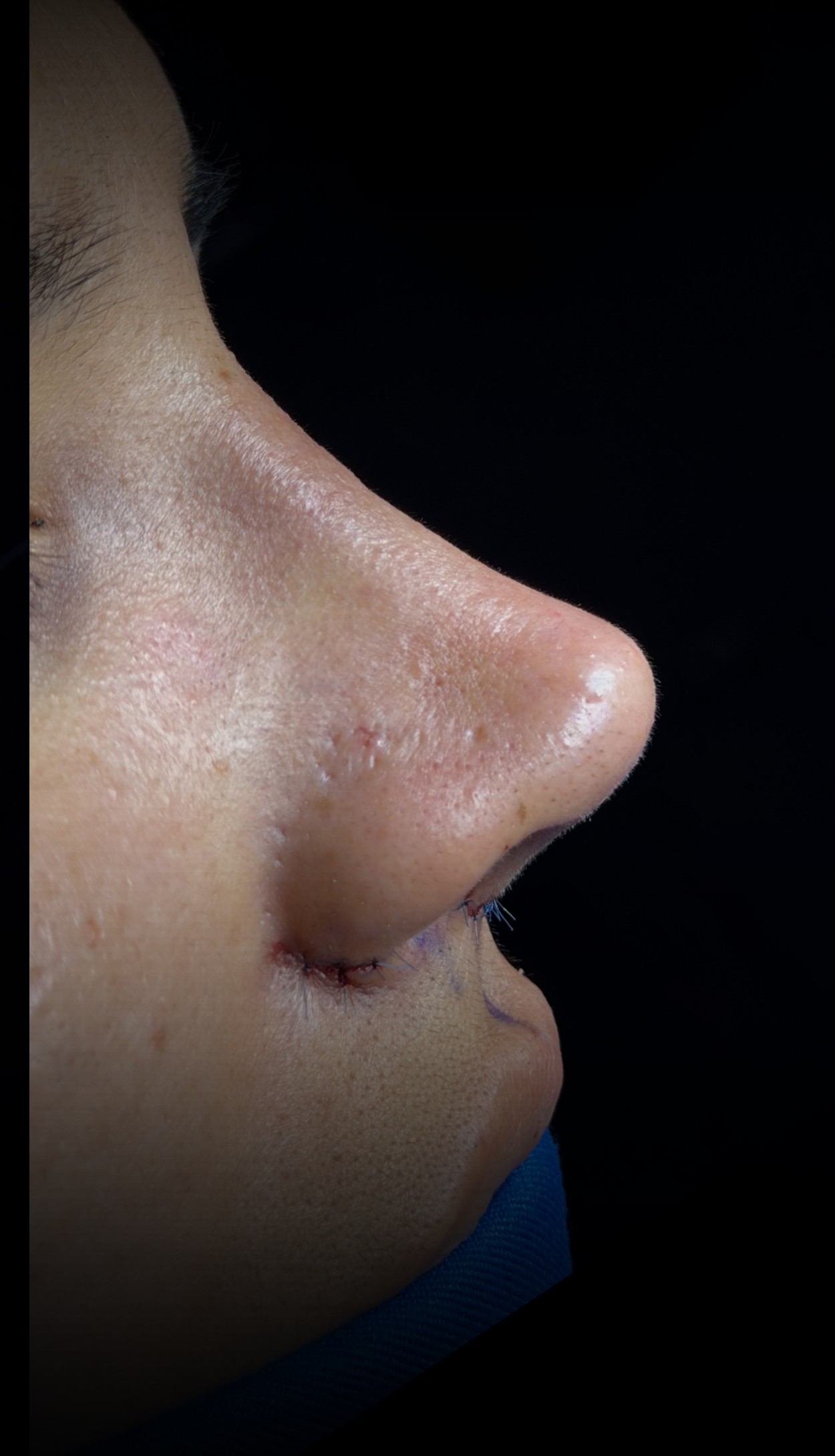 Comparación de perfil nasal antes y después del Caso 01 — después